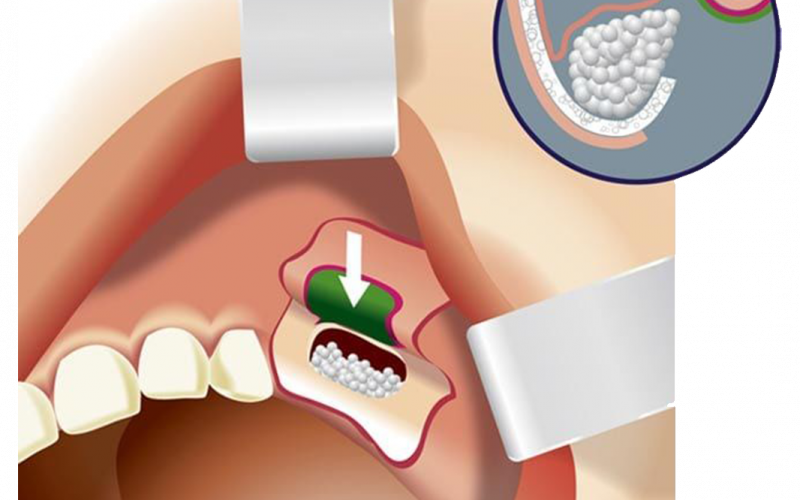 The Future of Bone Graft Powders in Dentistry