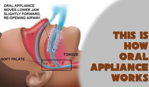 CPAP Machines: How They Help Treat Apneia